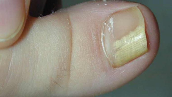 μυκητες-νυχιων-featured-articles